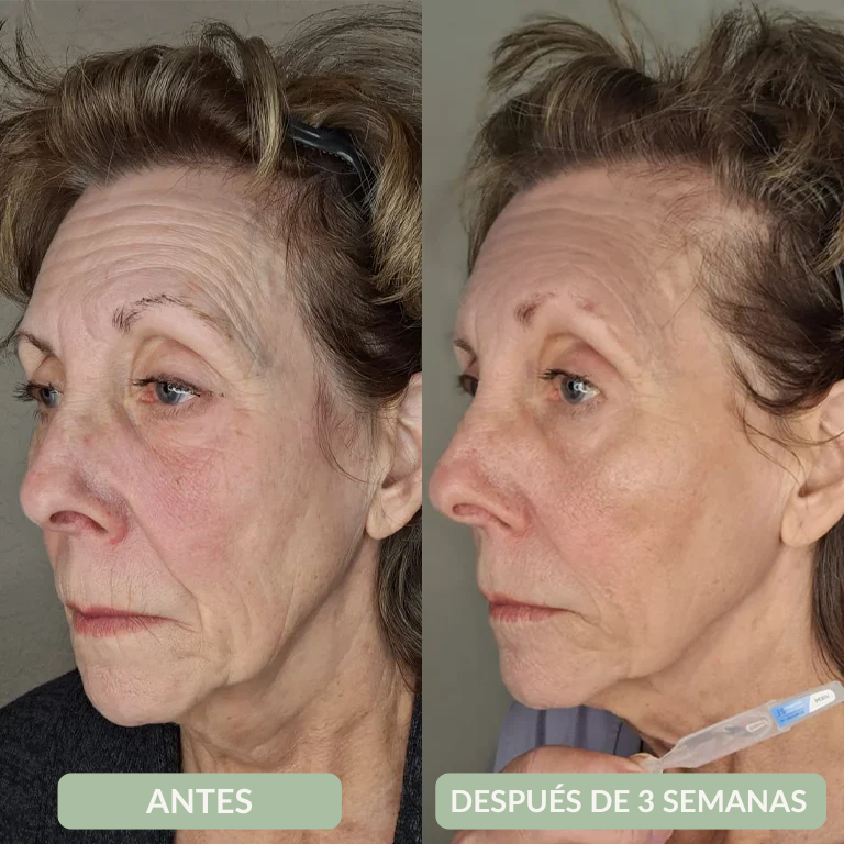 Arrugas y Elasticidad