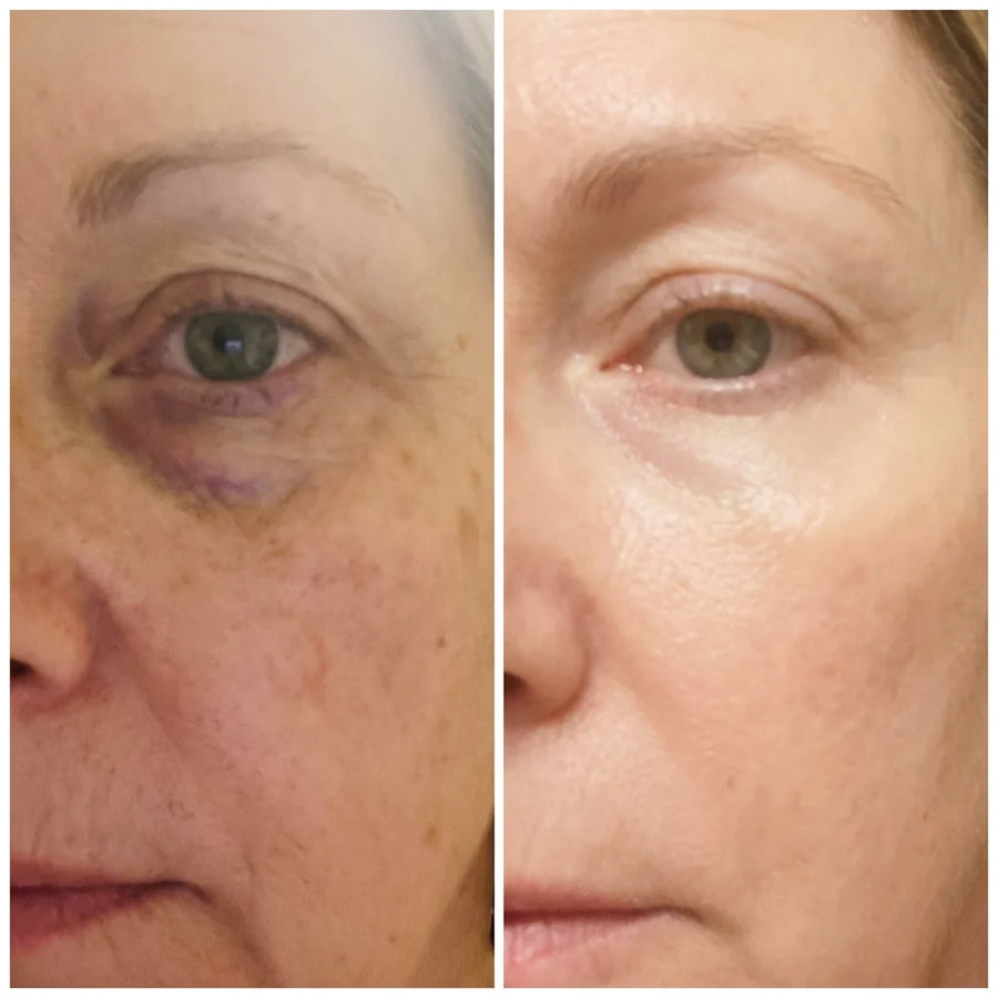 Bolsas y Ojeras
